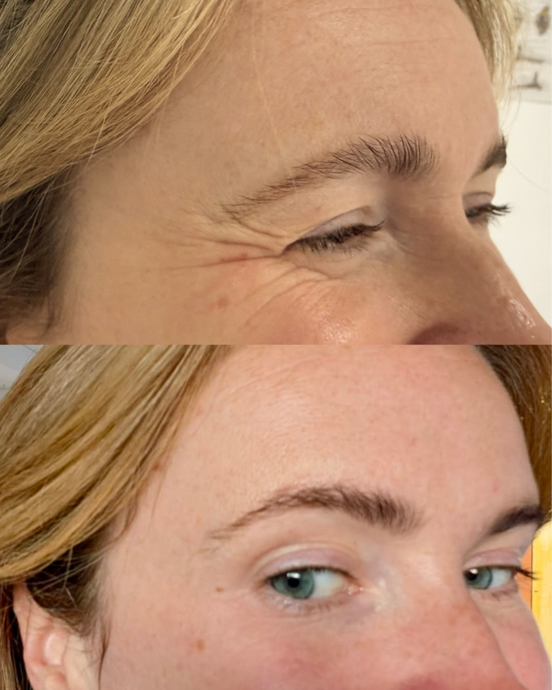 Crow's Feet before and after treatment result