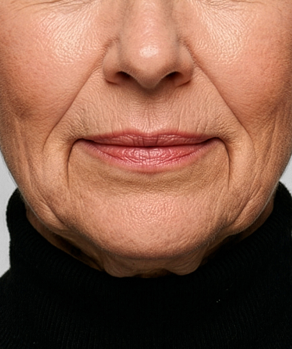 Marionette Lines (Corners of the Mouth)
