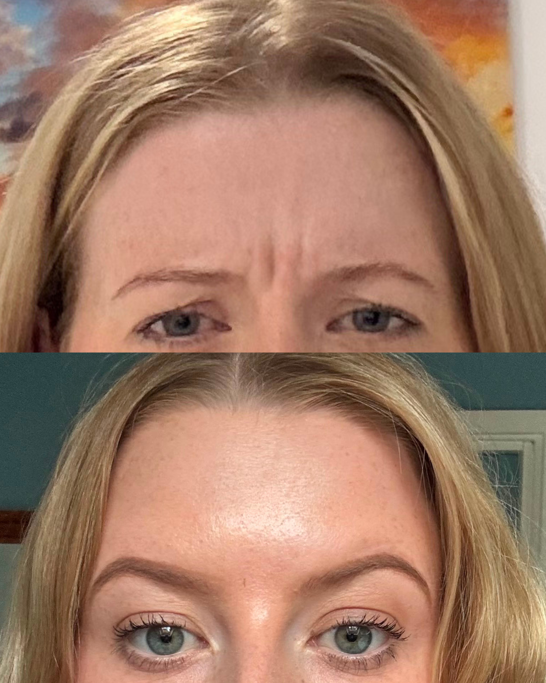 Frown Lines before and after treatment result