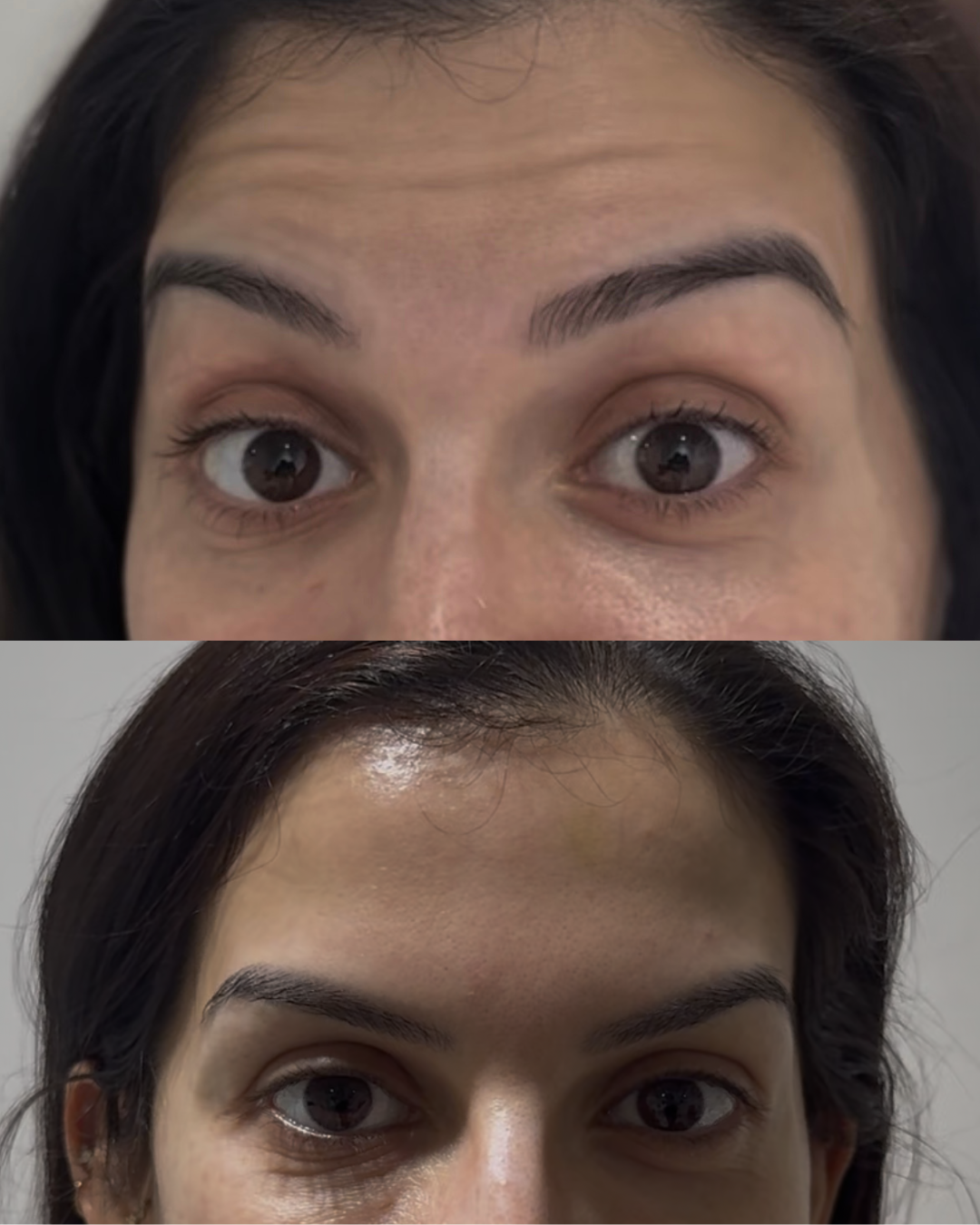Forehead Lines before and after treatment result