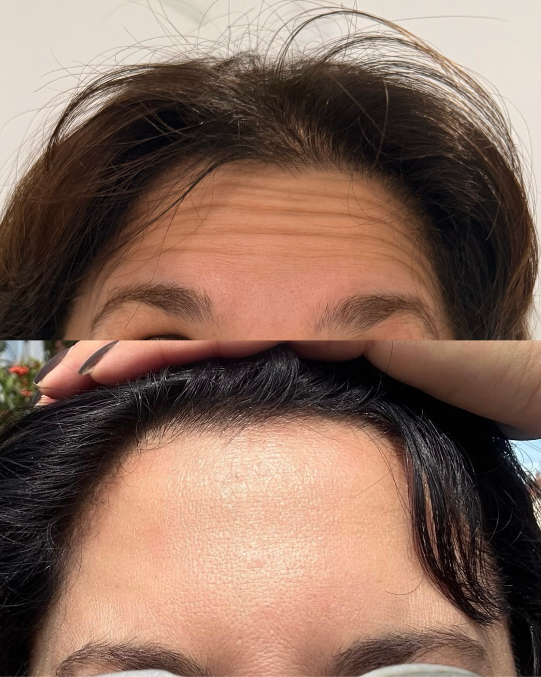 Forehead Lines before and after treatment result