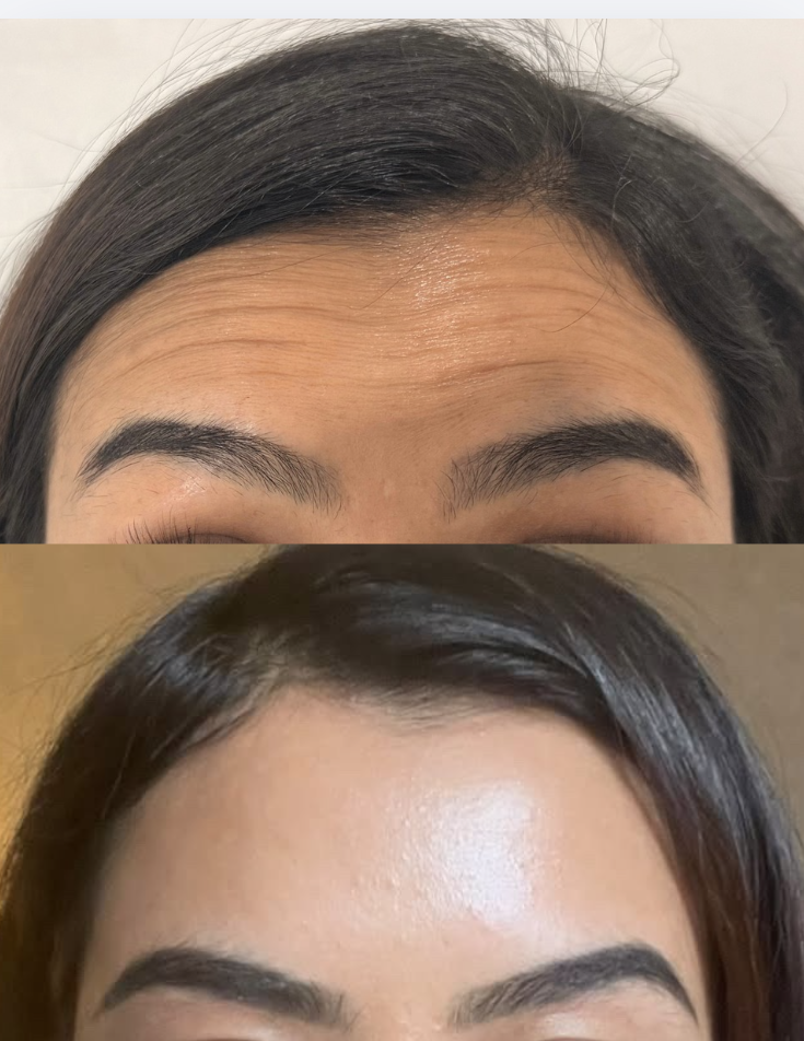 Forehead Lines before and after treatment result