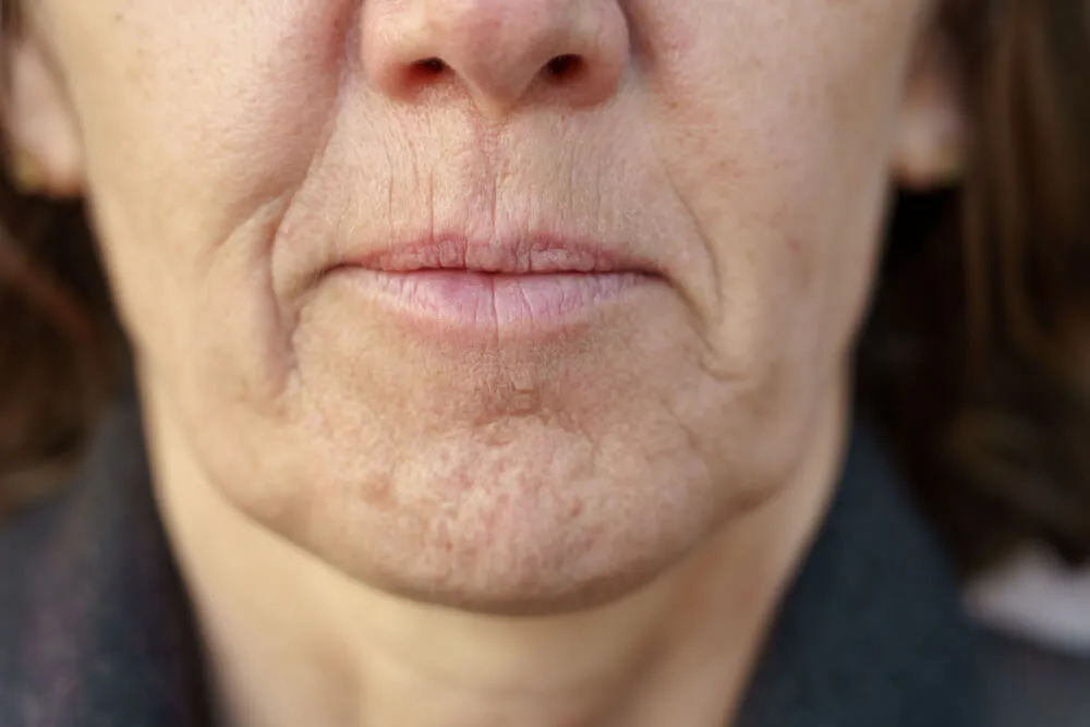 Pebbled Chin